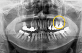 図2 同、パノラマＸ線写真。lu67は無髄歯と思われる