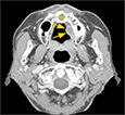 図3 同、造影CT（＊：鼻口蓋管嚢胞／矢印：腫瘤性病変）