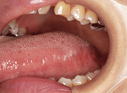 図1 初診時の口腔内写真（舌左側）