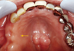 図1 初診時の口腔内写真。上顎右側顎堤および周囲組織にあきらかな炎症所見は観察されない（矢印）
