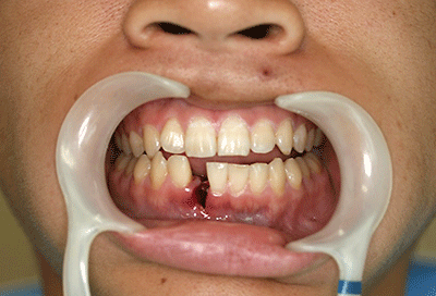 図1 初診時の口腔内写真