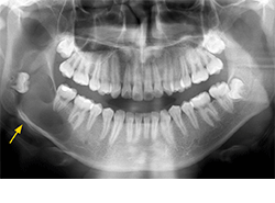 図1 初診時のパノラマＸ線写真。病変内には埋伏歯を、下縁部には骨膜反応を認めた（矢印）