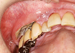 図1　初診時の口腔内写真