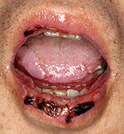 図1　初診時の口唇写真