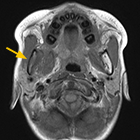 図3 同、T1強調MRI写真