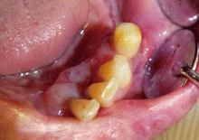 図1 下顎左側小臼歯部、歯肉頬移行部粘膜
