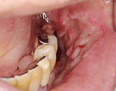 図2 骨露出部に隣接する頬粘膜に、潰瘍性病変を認める