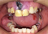 図1　初診時の口腔内写真