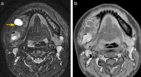 図2 MRI画像。a：STIR、b：Gd造影脂肪抑制T1強調像
