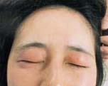 図 2 キシロカインCtによる眼の浮腫