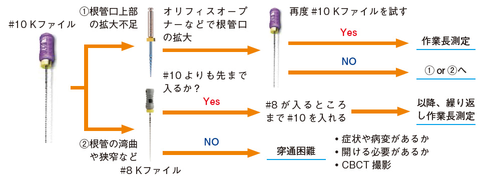 石灰化、湾曲などで穿通できない場合の対処法（穿通には#10 のK ファイルを用いる）