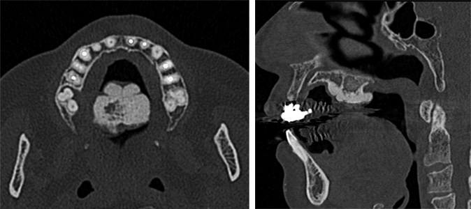 図❷　初診時のCT 画像（左：水平断、右：矢状断）