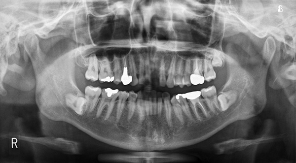 図❷　初診時のパノラマＸ線写真
