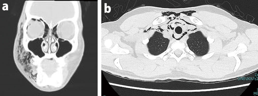 図❸　CT 像。ａ：顔面の冠状断、ｂ：胸部の水平断｜PMTC中に生じた右眼周囲から頸部にかけての痛み