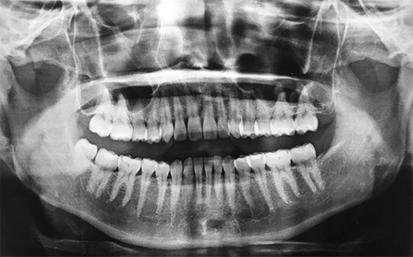 図❶　初診時のパノラマX 線写真