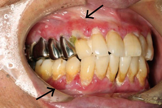 図❶　初診時の口腔内写真。両側上下顎辺縁歯肉にびらん、発赤を認める　Dd診断力てすと　口蓋の腫脹｜難治性の歯肉びらん