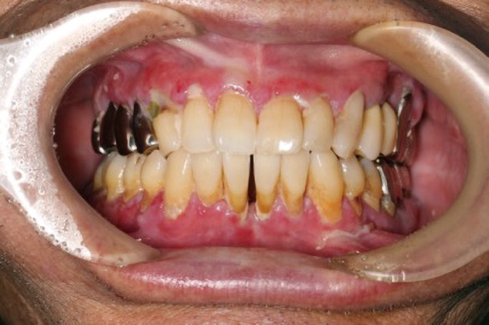 図❶　初診時の口腔内写真。両側上下顎辺縁歯肉にびらん、発赤を認める　Dd診断力てすと　口蓋の腫脹｜難治性の歯肉びらん