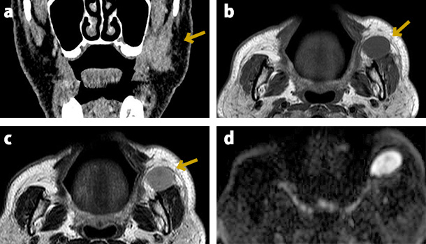 図❷　CT 画像およびMRI 画像（ａ：造影CT 画像［冠状断］、ｂ：MRI T1 画像、ｃ：MRI T2 画像、d：MRI 拡散強調画像）