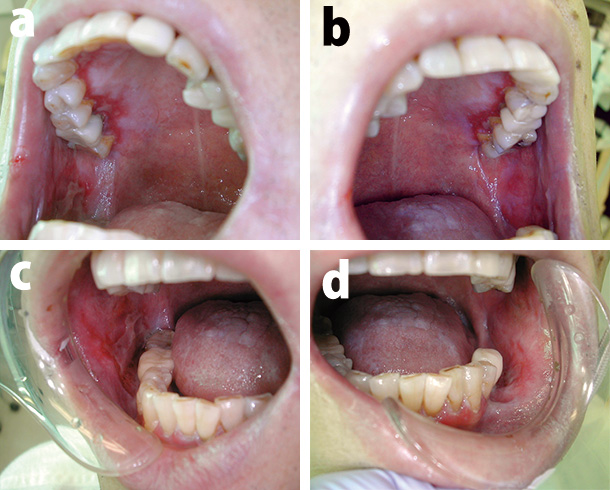 図❶　初診から約４週間後の口腔内所見。両側頰粘膜に潰瘍と辺縁歯肉に糜爛を認める