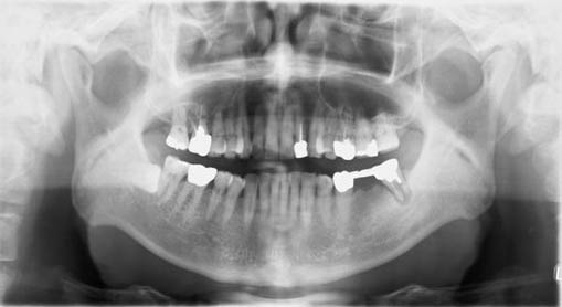 図❷　初診時のパノラマＸ線写真