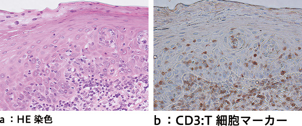 図❸　病理組織像と免疫染色。上皮直下および上皮内に浸潤するCD3 陽性細胞を認める