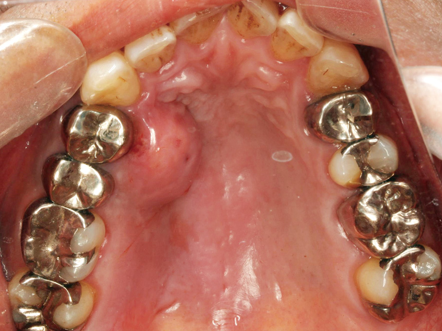 図❶　初診時の口腔内写真（ミラー像）　Dd診断力てすと　口蓋の腫脹