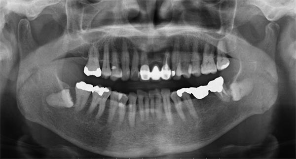 図❷　初診時のパノラマＸ線写真