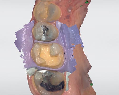 図❺　Digital scanning under rubber dam で得られたスキャン画像。ラバーダム防湿下に光学印象を応用した術式である