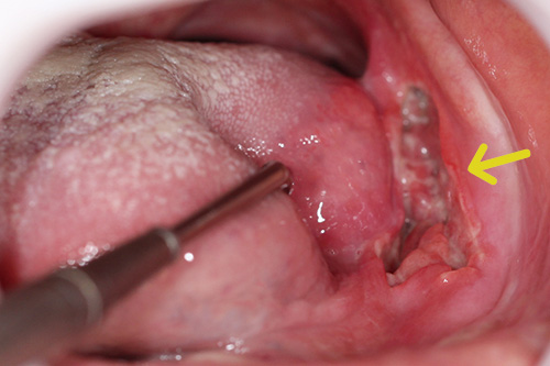 図❶　初診時の口腔内写真（矢印：潰瘍性病変）｜口底部の潰瘍