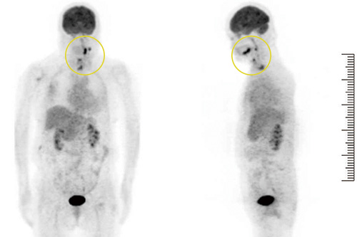 図❷　初診時のPET 画像（SUVmax：口腔内7.4、頸部3.7、脊椎2.8）