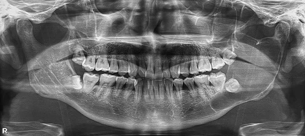 図❶　初診時のパノラマＸ線写真