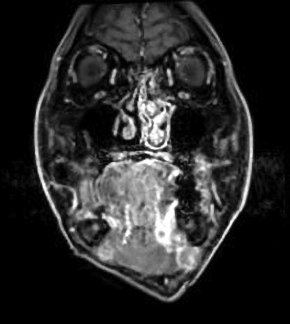 ｂ：造影MRI 画像