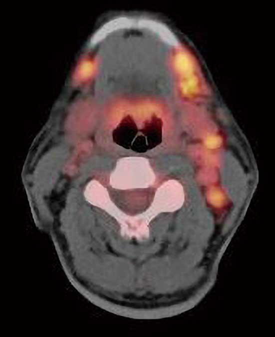 ｃ：FDG-PET/CT 画像