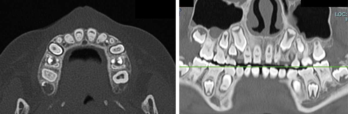 図❸　CT 画像（ 左： 11歯頸部付近の水平断、右：CPR 画像）