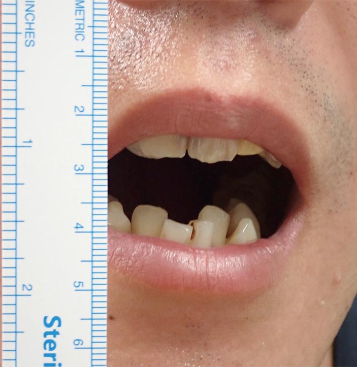 図❶　当院初診時の開口量（8mm）
