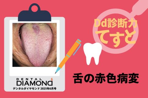 Dd診断力てすと『舌の赤色病変』デンタルダイヤモンド 2025年6月号
