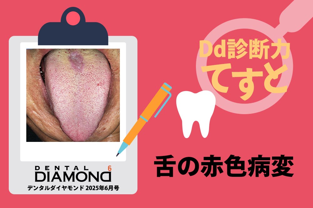 Dd診断力てすと『舌の赤色病変』デンタルダイヤモンド 2025年6月号