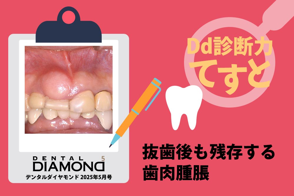 Dd診断力てすと『抜歯後も残存する歯肉腫脹』デンタルダイヤモンド 2025年5月号