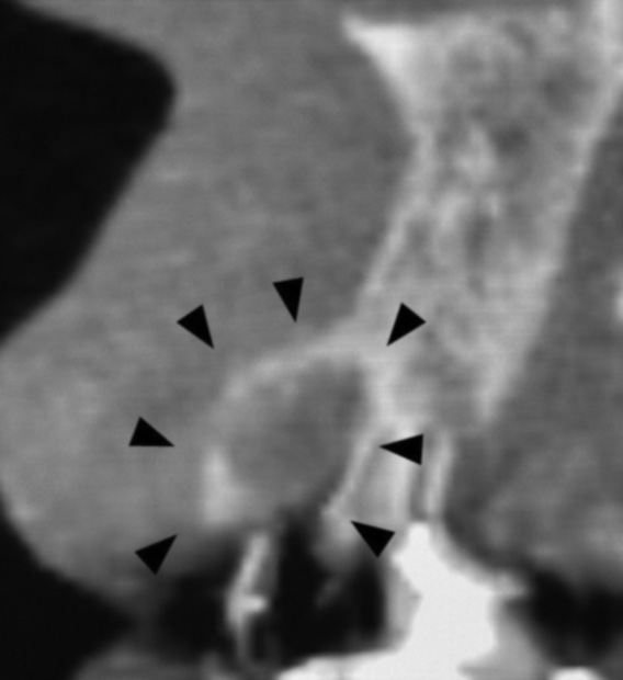図❸ CT 矢状断