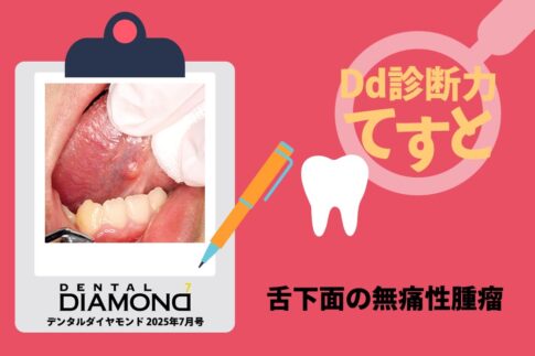 Dd診断力てすと『舌下面の無痛性腫瘤』デンタルダイヤモンド 2025年7月号