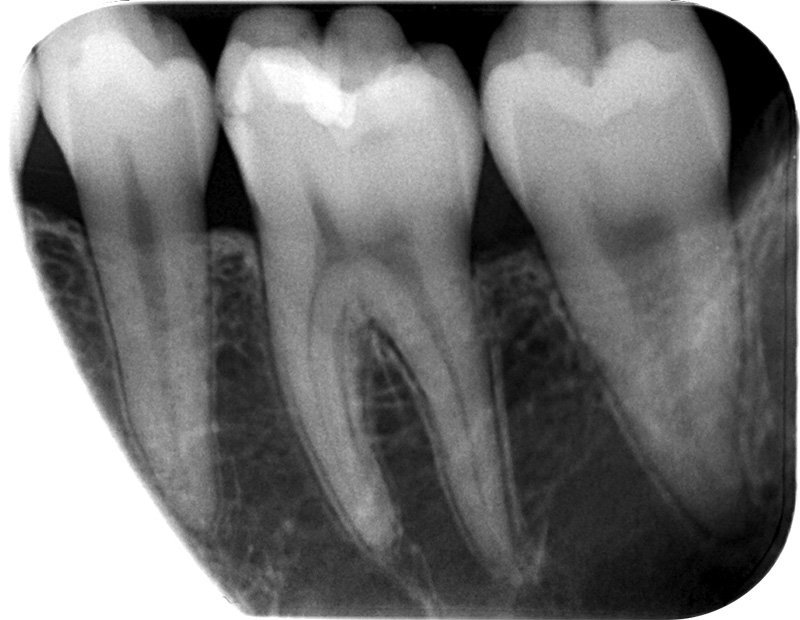 図❷ 初診時のデンタルX線写真