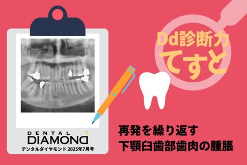 Dd診断力てすと『再発を繰り返す下顎臼歯部歯肉の腫脹』デンタルダイヤモンド 2025年7月号