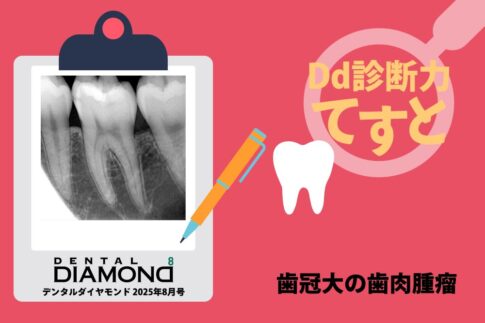 Dd診断力てすと『歯冠大の歯肉腫瘤』デンタルダイヤモンド 2025年8月号