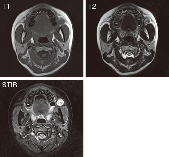 図❷　MRI 画像