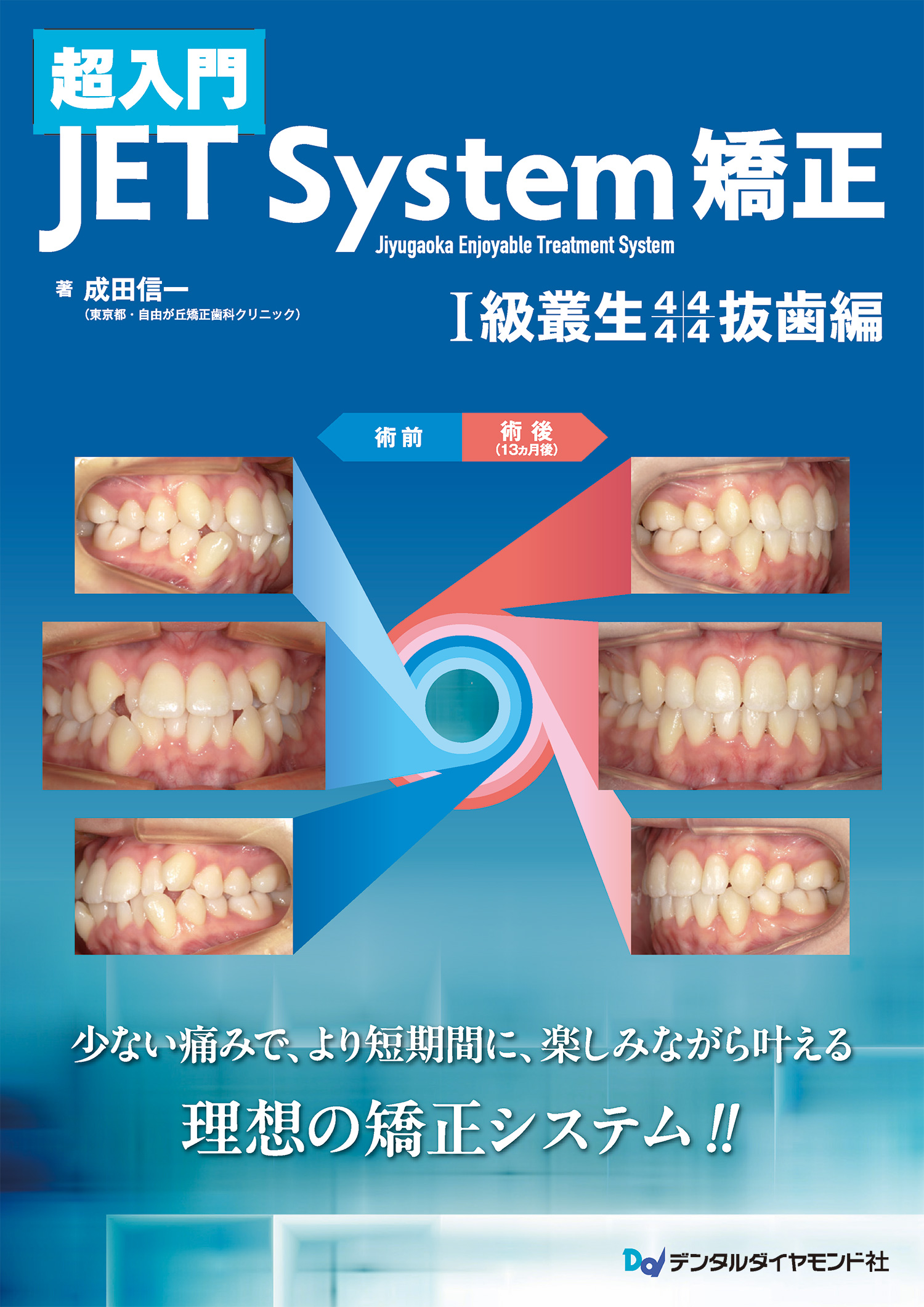 超入門 JET System矯正 Ⅰ級叢生4444抜歯編