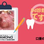 Dd診断力てすと『口蓋の腫瘤』デンタルダイヤモンド 2025年10月号
