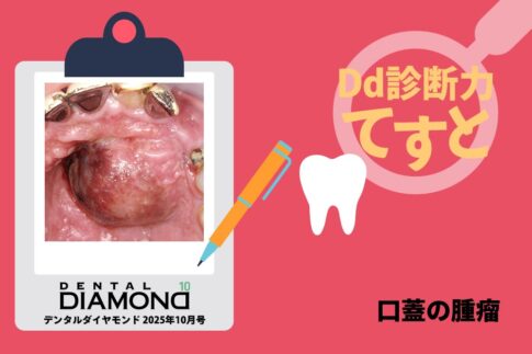 Dd診断力てすと『口蓋の腫瘤』デンタルダイヤモンド 2025年10月号