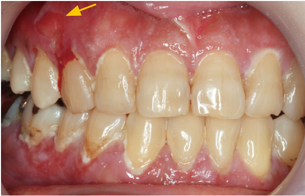 図❶　初診時の口腔内写真。口腔粘膜全体に水疱の潰れた痕が多数あり、上皮が剝離している部分を認める（矢印）