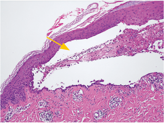 図❸　病理像（HE 染色）。表皮内に水疱を形成している（矢印）