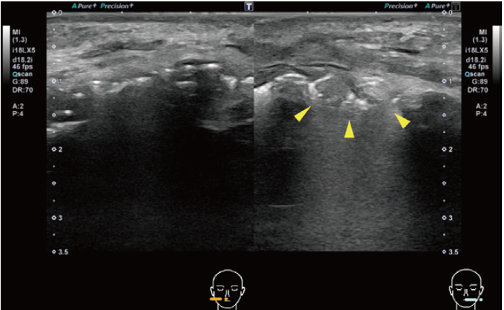 図❷ 初診時のUS 像